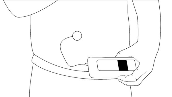 Figure 2 - The medication pump connects via a thin tube to a subcutaneous catheter in the abdominal wall
